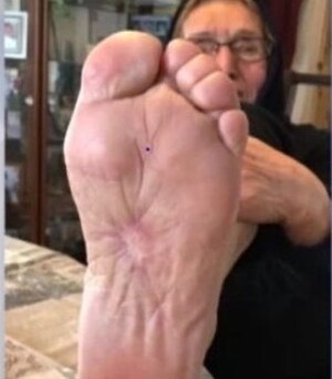 آثار شکنجه‌ی ساواک بر پای عزیز رضایی